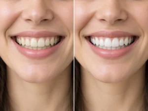 Clareamento dental